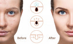 Electric Vacuum Pore Cleaner Blackhead Remover Acne Facial Suction Machine